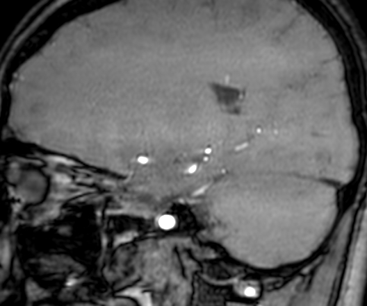 Cerebral arteriovenous malformation at posterior body of corpus callosum (Radiopaedia 74111-84925 J 135).jpg