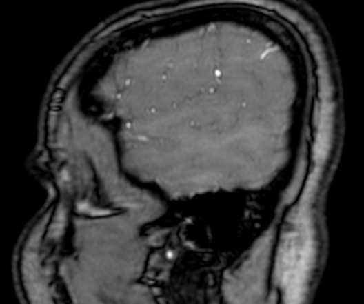 Cerebral arteriovenous malformation at posterior body of corpus callosum (Radiopaedia 74111-84925 J 19).jpg