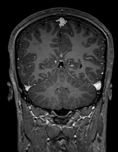Cerebral arteriovenous malformation at posterior body of corpus callosum (Radiopaedia 74111-84925 K 269).jpg