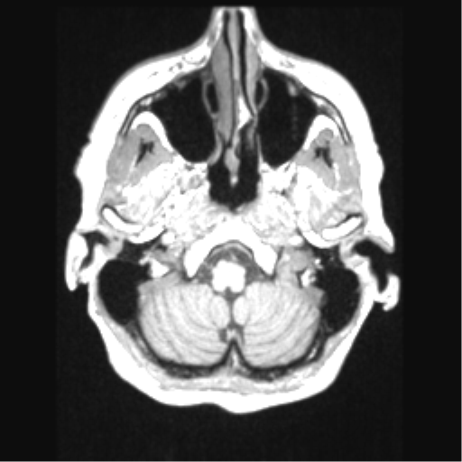 File:Cerebral arteriovenous malformation with hemorrhage (Radiopaedia 34422-35737 Axial T1 12).png