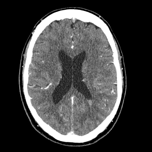 Cerebral arteriovenous malformation with lobar hemorrhage (Radiopaedia 35598-57216 A 37).jpg