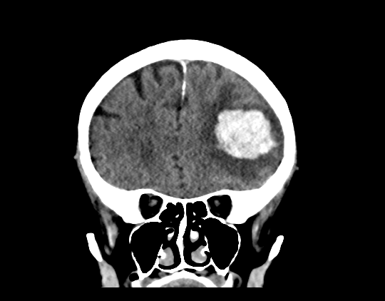 Cerebral arteriovenous malformation with lobar hemorrhage (Radiopaedia 44725-48510 Coronal non-contrast 17).png