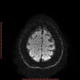 File:Cerebral cavernous malformation (Radiopaedia 26177-26306 Axial DWI 19).jpg