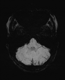 Cerebral cavernous venous malformation (Radiopaedia 70008-80021 Axial SWI 12).jpg