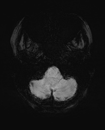 Cerebral cavernous venous malformation (Radiopaedia 70008-80021 Axial SWI 6).jpg