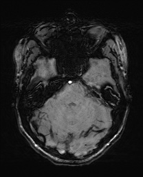 File:Cerebral cavernous venous malformation (Radiopaedia 70008-80021 I 21).jpg
