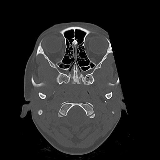 Cerebral cavernous venous malformation (Radiopaedia 70008-80022 Axial bone window 1).jpg