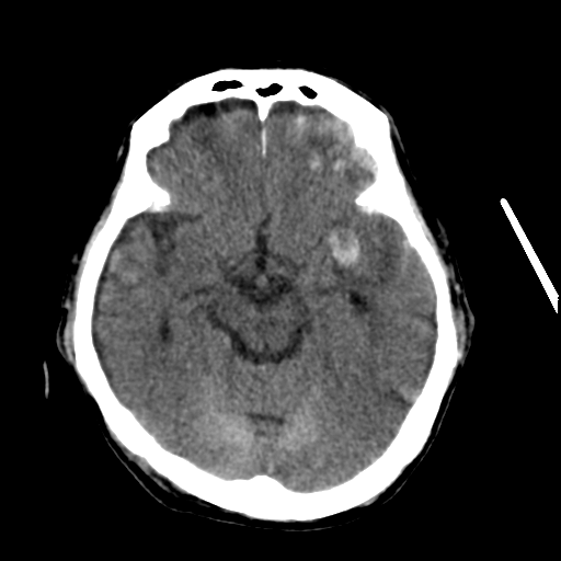 File:Cerebral contusions, subarachnoid hemorrhage and subdural hygromas (Radiopaedia 55399-61827 Axial non-contrast 15).png