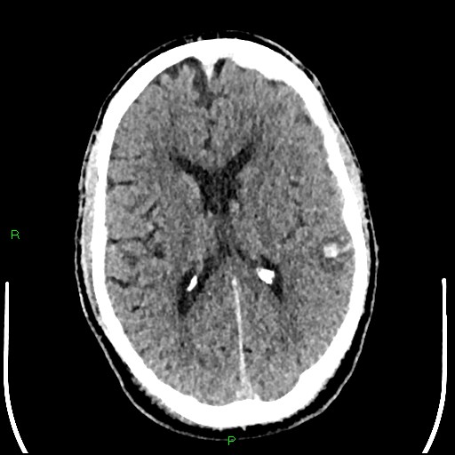 Cerebral contusions (Radiopaedia 33868-35039 Axial non-contrast 120).jpg