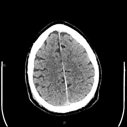 Cerebral contusions (Radiopaedia 33868-35039 Axial non-contrast 169).jpg