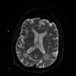 Cerebral embolic infarcts (embolic shower) (Radiopaedia 49837-55108 Axial DWI 20).jpg