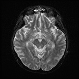 Cerebral embolic infarcts (embolic shower) (Radiopaedia 72391-82921 Axial DWI 12).jpg