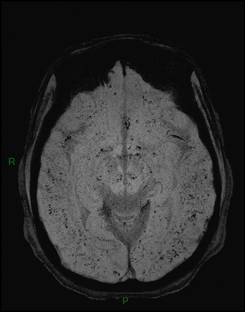 Cerebral fat embolism (Radiopaedia 35022-36525 Axial SWI 11).jpg