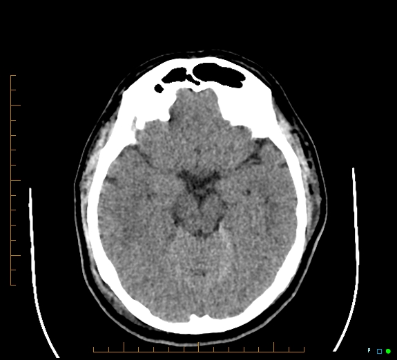 File:Cerebral fat embolism (Radiopaedia 85521-101220 Axial non-contrast 27).jpg