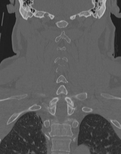 Cerebral hemorrhagic contusions and cervical spine fractures (Radiopaedia 32865-33841 Coronal bone window 48).jpg