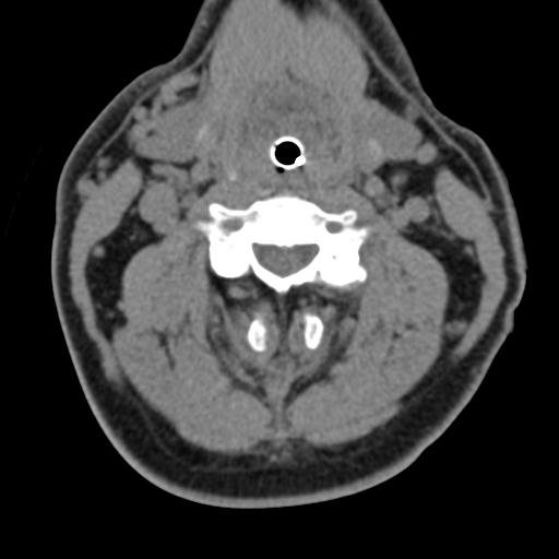 Cerebral hemorrhagic contusions and cervical spine fractures (Radiopaedia 32865-33841 F 24).jpg