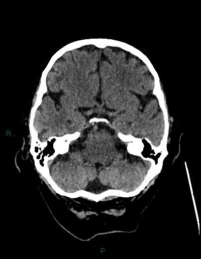 File:Cerebral metastases - ependymal and parenchymal (Radiopaedia 79877-93131 Axial non-contrast 17).jpg