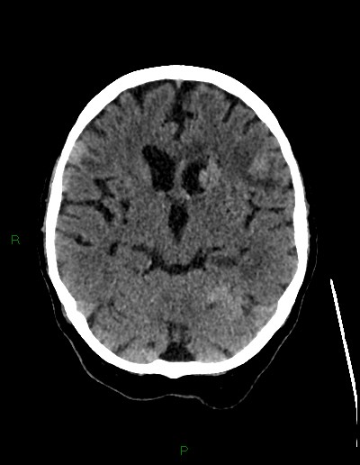 File:Cerebral metastases - ependymal and parenchymal (Radiopaedia 79877-93131 Axial non-contrast 32).jpg