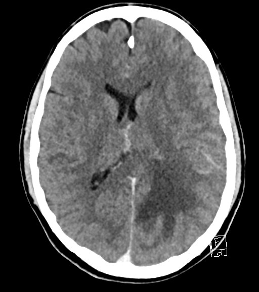 Cerebral metastases - testicular choriocarcinoma (Radiopaedia 84486-99855 Axial C+ delayed 27).jpg
