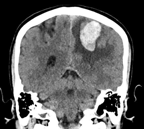 Cerebral metastases - testicular choriocarcinoma (Radiopaedia 84486-99855 Coronal C+ delayed 42).jpg