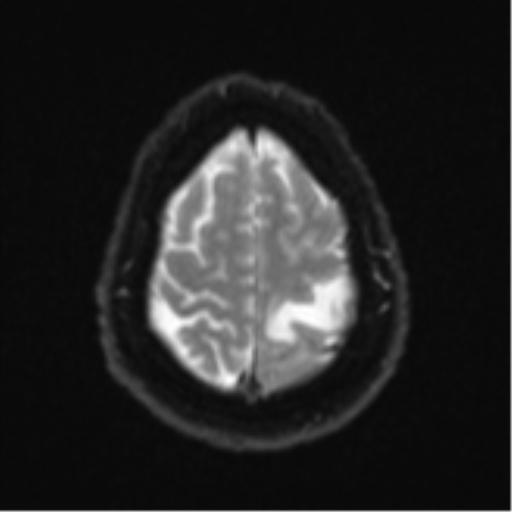 Cerebral metastases mimicking multifocal glioblastoma (Radiopaedia 50843-56353 Axial DWI 23).png