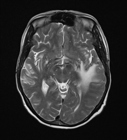 File:Cerebral metastasis (Radiopaedia 46744-51248 Axial T2 12).png