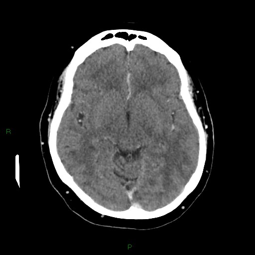 File:Cerebral metastasis from renal cell carcinoma (Radiopaedia 82306-96375 Axial C+ delayed 17).jpg