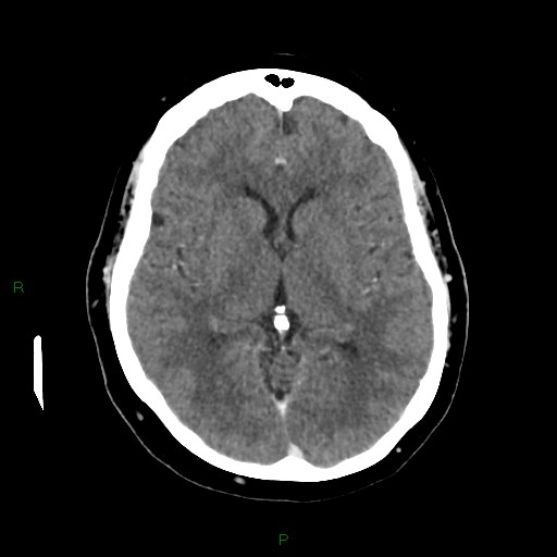 File:Cerebral metastasis from renal cell carcinoma (Radiopaedia 82306-96375 Axial C+ delayed 19).jpg