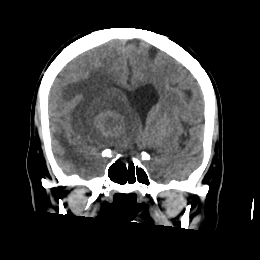 Cerebral metastasis to basal ganglia (Radiopaedia 81568-95412 Coronal non-contrast 30).png