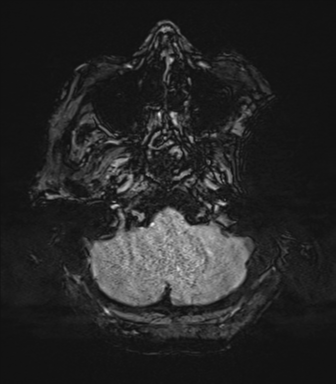 Cerebral metastasis to basal ganglia (Radiopaedia 81568-95413 Axial SWI 10).png