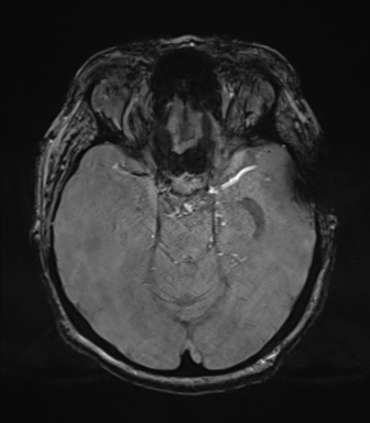 Cerebral metastasis to basal ganglia (Radiopaedia 81568-95413 Axial SWI magnitude 30).png