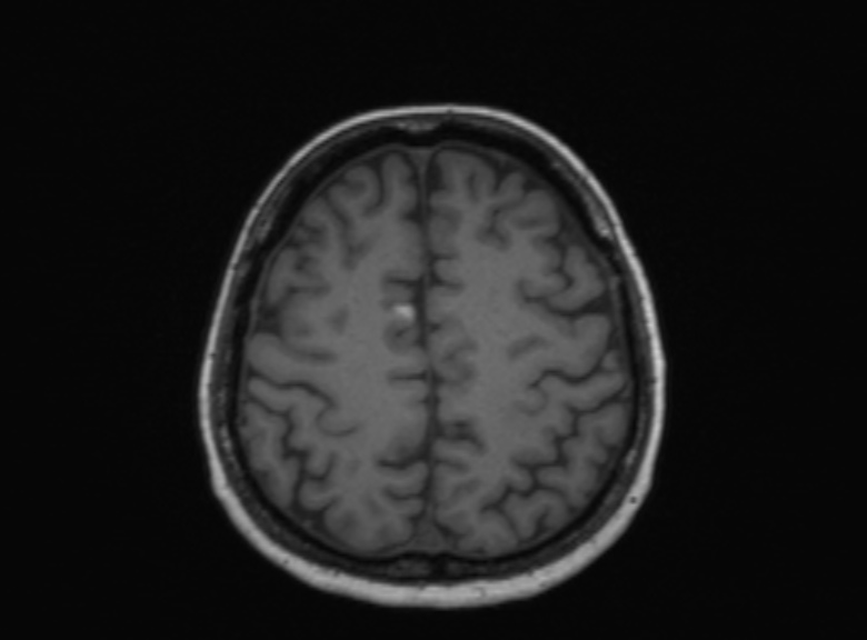 Cerebral ring enhancing lesions - cerebral metastases (Radiopaedia 44922-48817 Axial T1 156).jpg