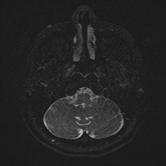Cerebral ring enhancing lesions - cerebral metastases (Radiopaedia 44922-48817 F 6).jpg