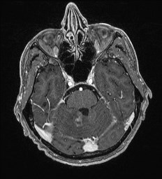Cerebral toxoplasmosis (Radiopaedia 43956-47461 Axial T1 C+ 20).jpg