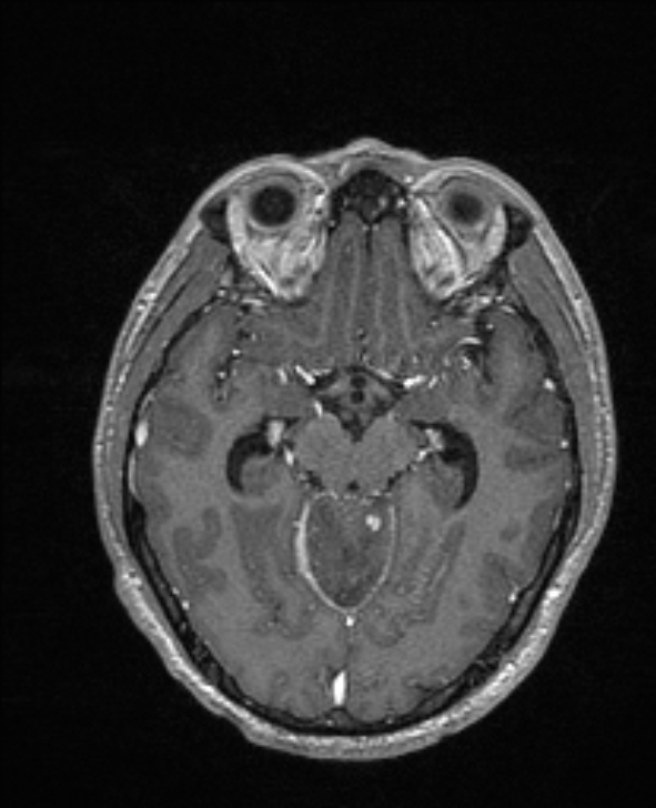 Cerebral toxoplasmosis (Radiopaedia 85779-101597 Axial T1 C+ 68).jpg