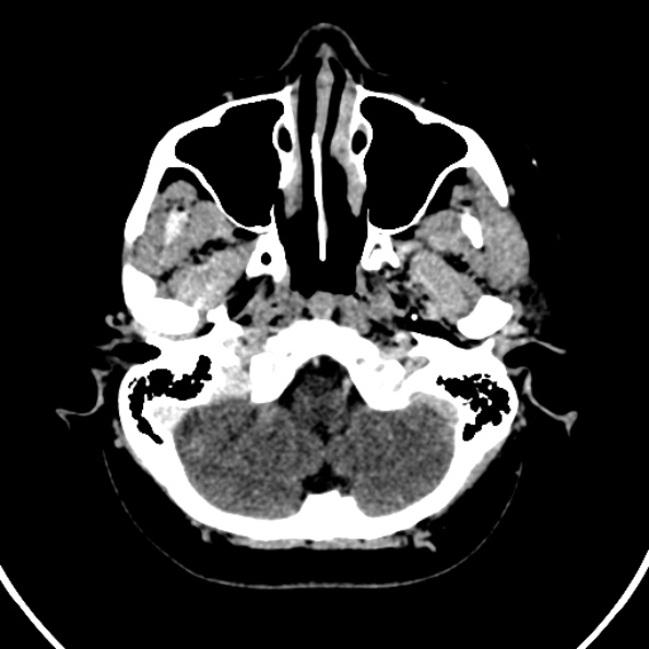 Cerebral venous hemorrhagic infarct from venous sinus thrombosis (Radiopaedia 55433-61883 Axial C+ delayed 128).jpg