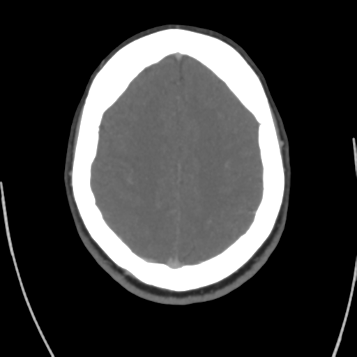 File:Cerebral venous infarct related to dural venous sinus thromboses (Radiopaedia 35292-36804 Axial C+ delayed 37).png