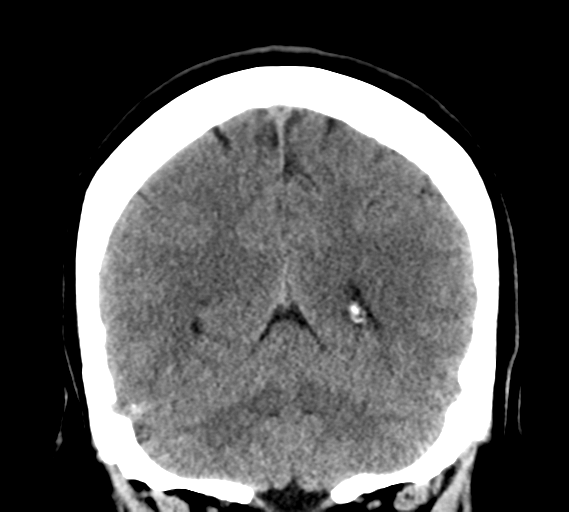 File:Cerebral venous infarct related to dural venous sinus thromboses (Radiopaedia 35292-36804 Coronal non-contrast 26).png