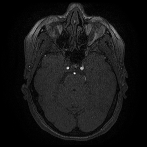Cerebral venous infarction (Radiopaedia 25109-25363 MRA 10).jpg