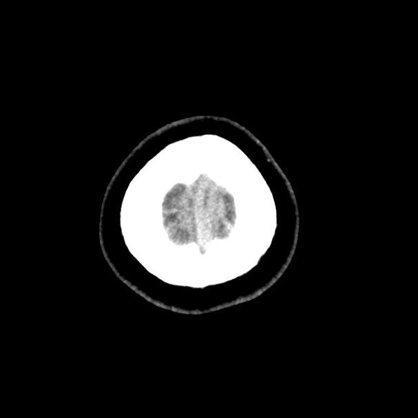 Cerebral venous sinus thrombosis (Radiopaedia 59224-66551 Axial non-contrast 61).jpg