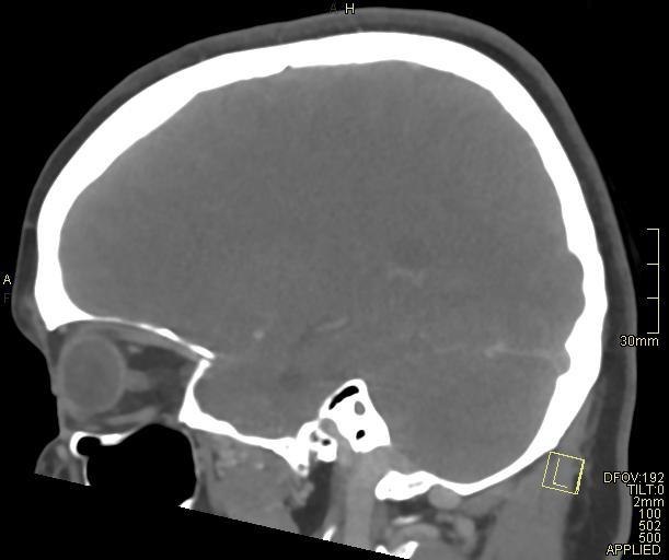 Cerebral venous sinus thrombosis (Radiopaedia 91329-108965 Sagittal venogram 26).jpg