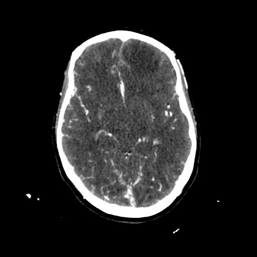 File:Cerebral venous throbmosis - hemorrhagic venous infarction (Radiopaedia 87318-103613 Axial CT venogram 13).jpg