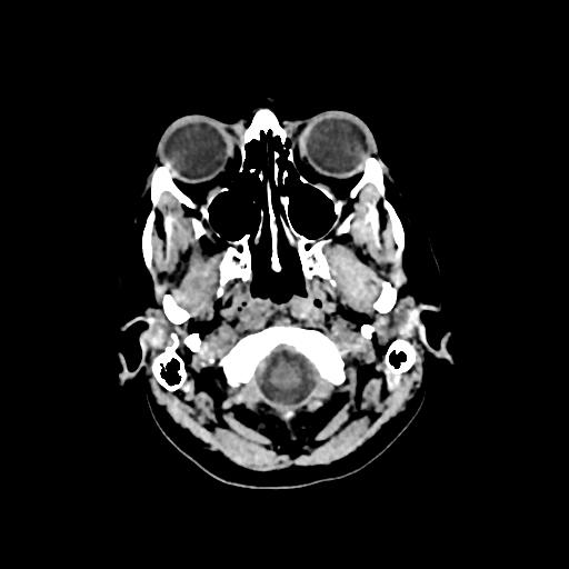 Cerebral venous throbmosis - hemorrhagic venous infarction (Radiopaedia 87318-103613 Axial non-contrast 12).jpg