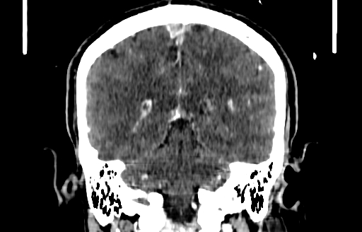 Cerebral venous thrombosis (CVT) (Radiopaedia 77524-89685 C 42).jpg