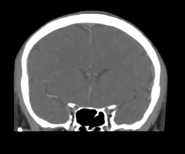 Cerebral venous thrombosis (Radiopaedia 38392-40467 Coronal CTA-Venogram 23).png