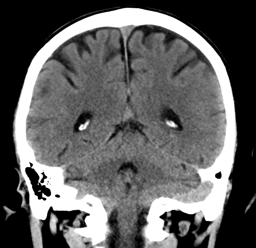 File:Cerebral venous thrombosis (Radiopaedia 38392-40467 Coronal non-contrast 26).png