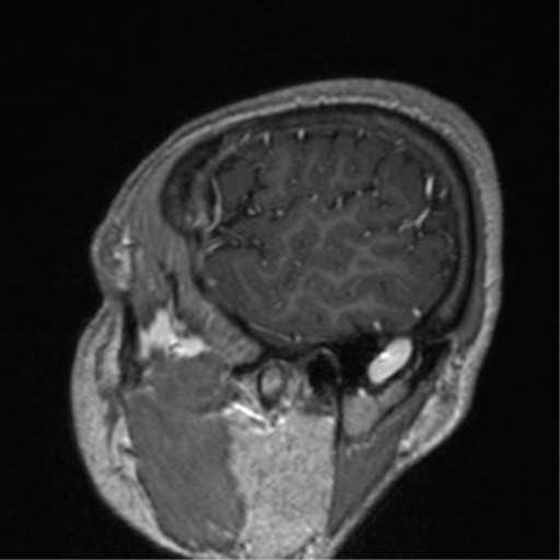 Cerebral venous thrombosis (Radiopaedia 38392-40469 Sagittal T1 C+ 16).png