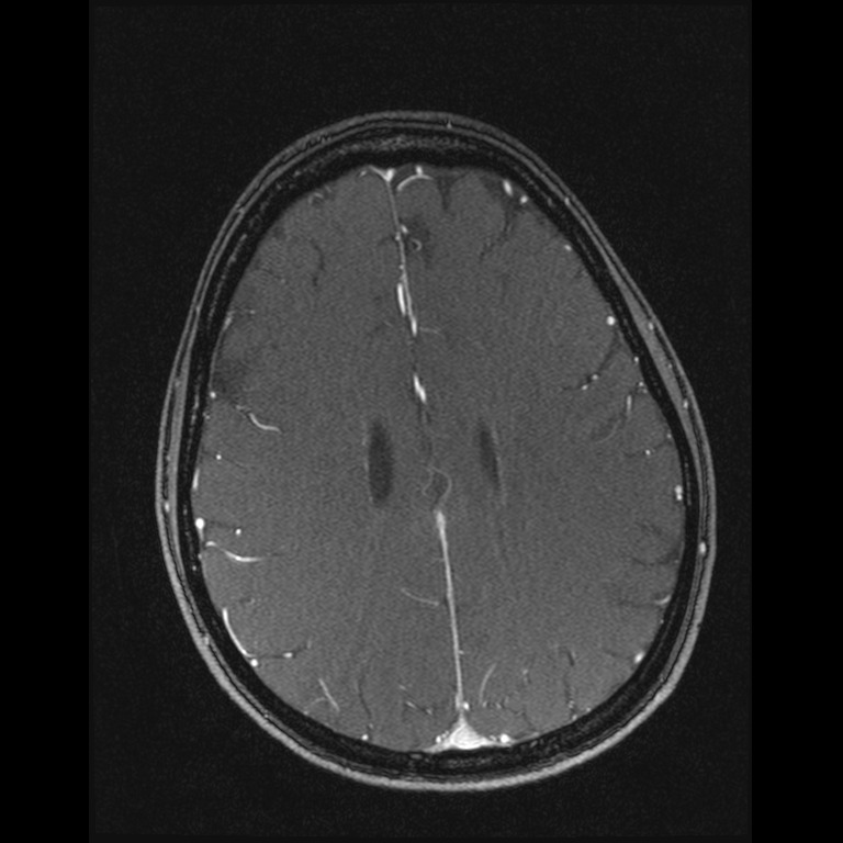 Cerebral venous thrombosis (Radiopaedia 45678-49854 Axial MRV 51).jpg