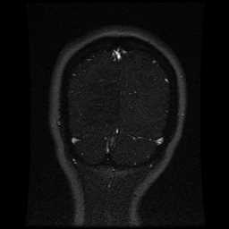 Cerebral venous thrombosis - ulcerative colitis (Radiopaedia 66049-75219 Coronal MRV 20).jpg