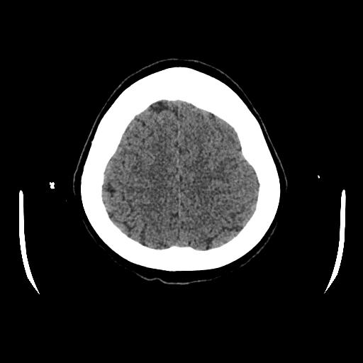 File:Cerebral venous thrombosis with venous hemorrhagic infarct (Radiopaedia 90354-107660 Axial non-contrast 42).jpg